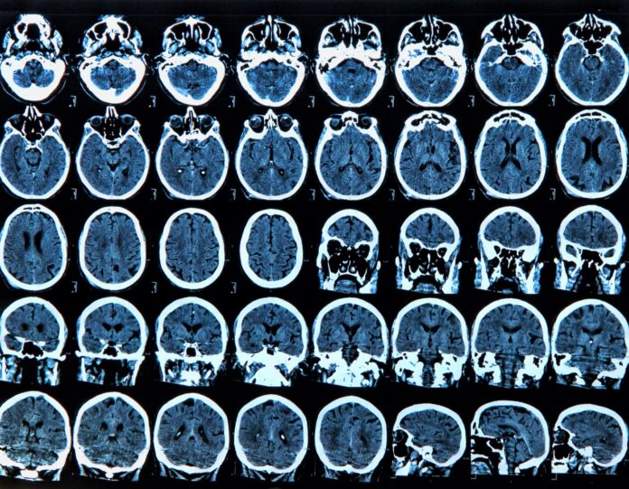 Aproape un milion de români suferă de boli neurologice rare: 1% din populație are epilepsie