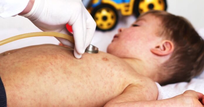 România, lider în UE la cazuri de rujeolă: o bombă cu ceas pe fondul scăderii vaccinării