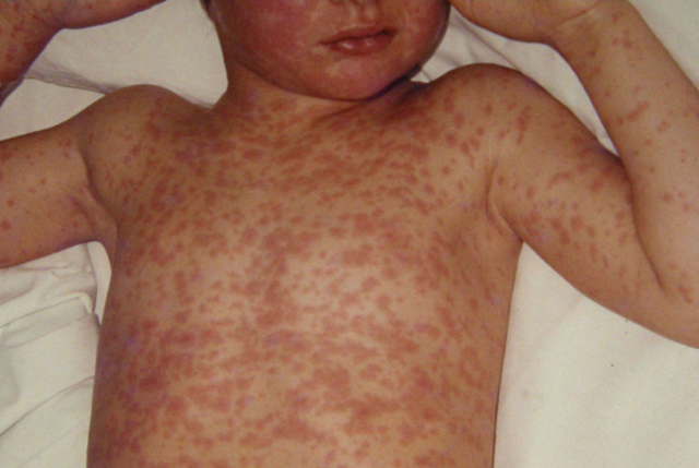 Sandra Alexiu avertizează despre impactul mediilor închise religioase asupra refuzului vaccinării în România, subliniind consecințele asupra sănătății copiilor.