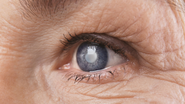 Eurostat: Operația de cataractă, cea mai frecventă procedură chirurgicală în spitalele UE în 2023; România, cea mai mică rată la 100.000 de locuitori; Peste un milion de cezariene în UE, cele mai multe în Cipru și România
